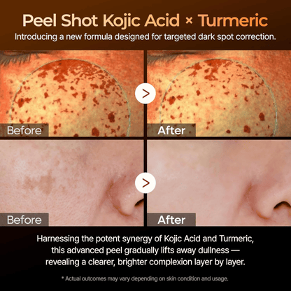 Dr.Melaxin Peel Shot Exfoliating Kojic Acid Turmeric Serum 80ml - cosmadic